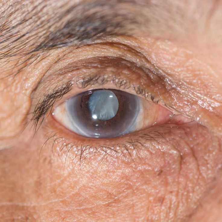 Cataract surgery