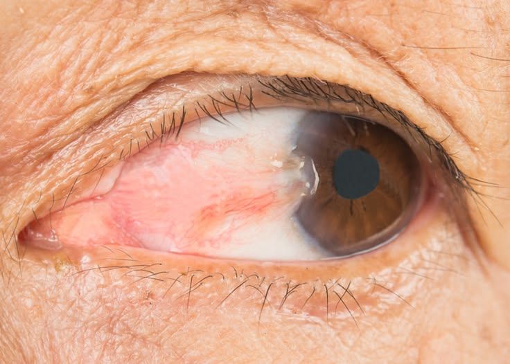 Pterygium excision surgery